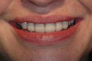 smile transformed with E-max veneers after