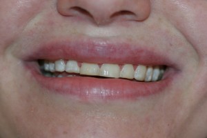 smile transformed with E-max veneers before