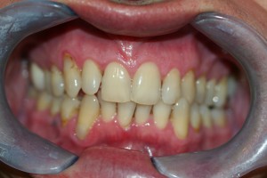 Before tooth whitening