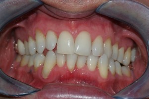 After tooth whitening