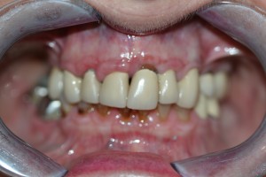 The initial situation. A failing upper set of crowns and bridges, with gum disease.