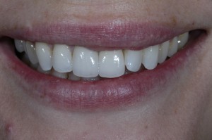 The new crowns are perfectly natural and blend in beautifully with the adjacent teeth.