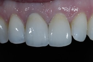 A close up image of the crowns. Note how they blend in with the gums and have natural characteristics which makes all the difference.