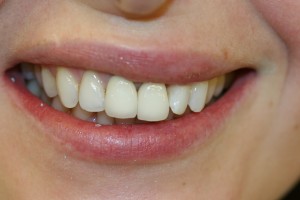 The original situation. The front teeth have crowns which are uneven and discoloured.