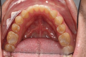 The end result after Social 6 braces. The front teeth have been straightened after only six months. A final retainer will need to be worn to maintain the new alignment.