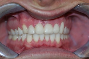 failing porcelian veneers placed on his 6 upper teeth