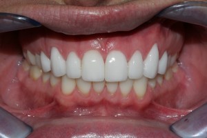 veneers were replaced with high quality E max veneers