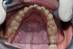 In this case study, teeth have started to move due to relapse after orthodontic treatment. Social 6 braces were placed to correct the problem.