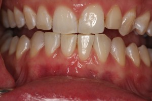 The gaps between the teeth are filled, the chips repaired. No drilling, no needles, no pain!