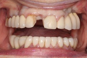 A missing front tooth. The adjacent teeth have successful dental