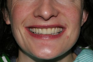 after porcelain veneers, a true smile transformation; cosmetic dental excellence