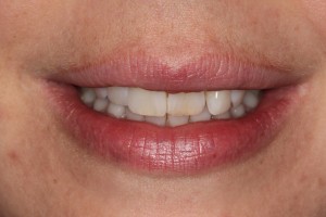 Front teeth which are slightly crooked on the patient left side