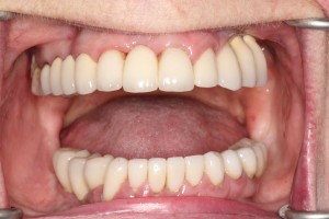 The completed bridge, a fantastic result. The patient can now smile again!