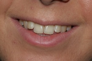 Front teeth which stick out and have irritated the patient for years