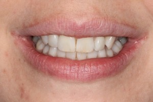 Teeth aligned and perfectly straight after only 6 weeks