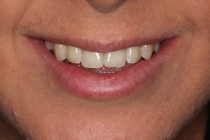 Straight teeth and a delighted patient, after only 12 weeks