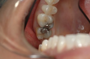 2 molar teeth with amalgam fillings