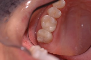 The same molar teeth with porcelain restorations. Just like natural teeth.