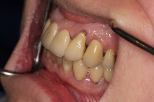 The dental implant in place - just like a natural tooth. A fantastic result.