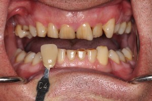 Dark teeth due to years of smoking