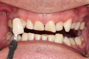 White teeth, in only 2 weeks!