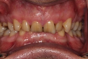 Tooth wear, discolouration and crowding all resulting