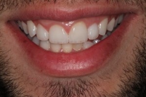 The final result- straight, white teeth!