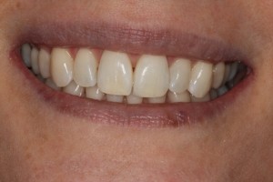 straight teeth, tooth whitening and cosmetic bonding- a perfect smile!