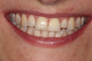 The tooth is visible again! After a course of invisible lingual braces, the tooth was brought back into alignment. Due to the previous position, it was heavily worn down over many years.