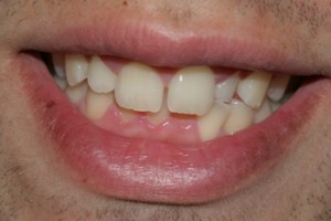 a crooked chipped front tooth and discolouration