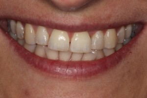 Cosmetic bonding restores the tooth to the natural shape.