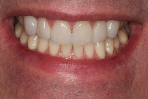 A smile transformation achieved with porcelain veneers