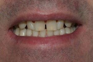 The original situation- worn teeth, gaps and discolouration