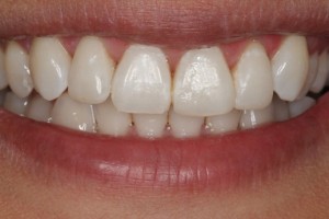 after photo of straight teeth