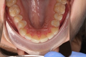 straight teeth in only 3 months after teeth straightening treatment