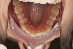 crooked front teeth before teeth straightening treatment