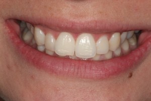 white teeth after only 2 weeks!