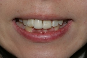 front tooth implant