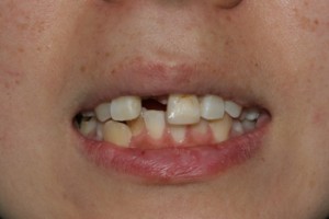 missing front tooth