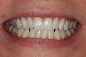 straight, white teeth, the laterals are now longer and symmetrical.