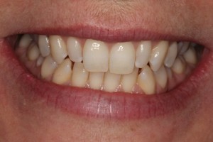 yellow, uneven teeth, note that the lateral teeth are very short