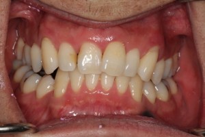 crooked upper teeth, spacing and uneven gum lines