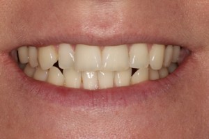 crooked front teeth and a forced smile.