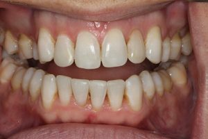 straight lower teeth