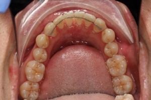 Straight teeth after lingual braces