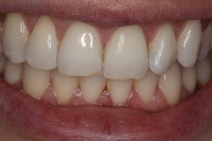 The right front tooth is short and worn. The left front toth also suffers from wear.