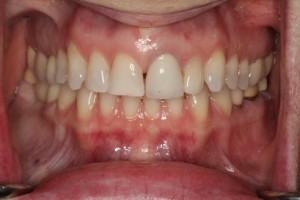 dental implant, straight teeth, cosmetic dentistry