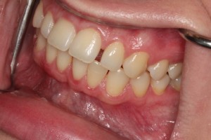 Spaces between teeth