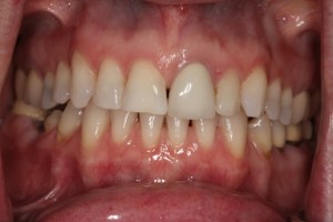 missing teeth, worn teeth, broken teeth