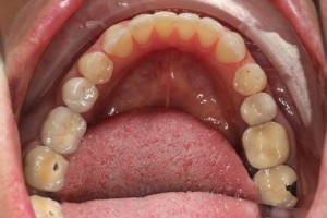 Dental implant, ceramic crown